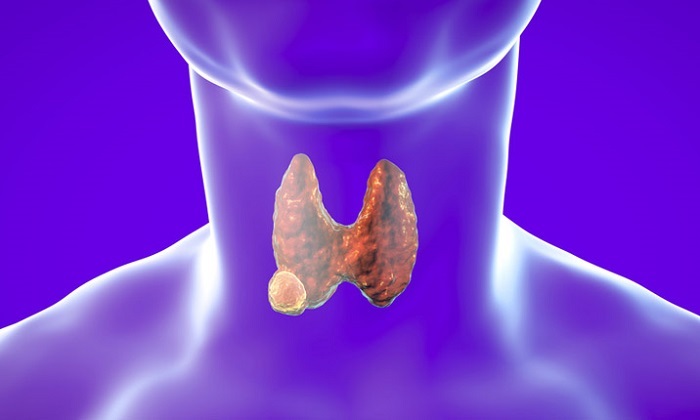 thyroid-nodule-cancer