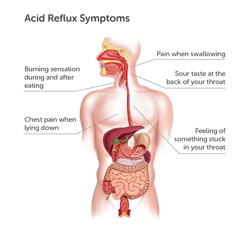 Acid Reflux Symptoms