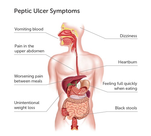 Peptic Ulcer Symptoms
